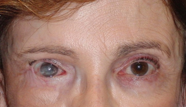 Clinical eye photograph illustrating Gold Weight Implant Facial Palsy