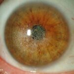 Clinical eye photograph illustrating Granular Corneal Dystrophy Management