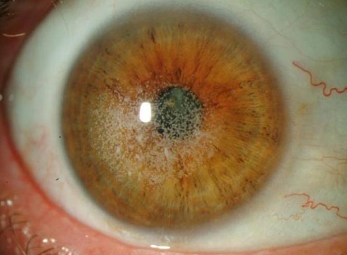 Granular Corneal Dystrophy: Breadcrumbs in the Stroma With Clear Windows Between