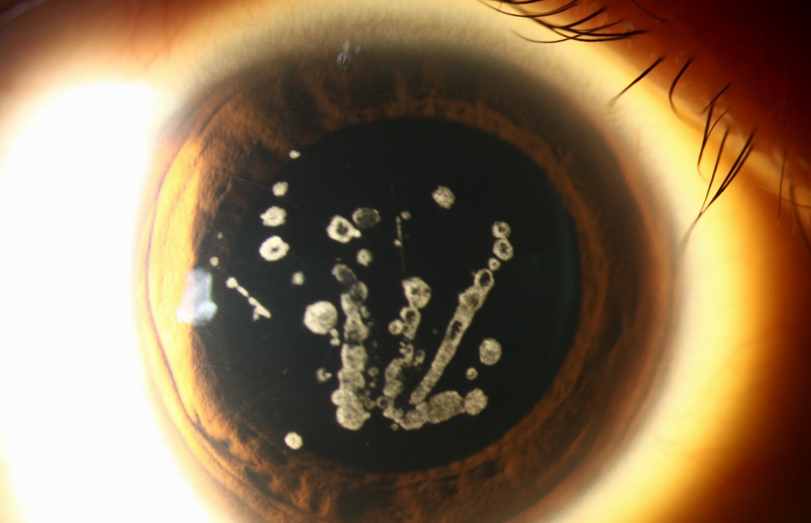 Clinical eye photograph illustrating Granular Corneal Dystrophy Management