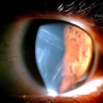 Clinical eye photograph illustrating Haab Striae
