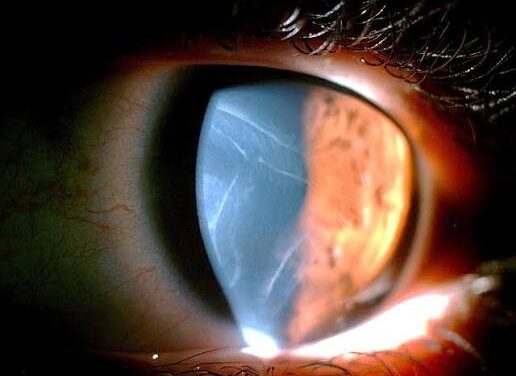 Haab Striae: The Horizontal Breaks in Descemet Membrane That Betray Congenital Glaucoma
