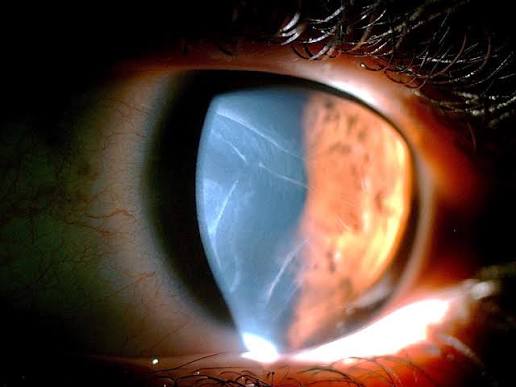 Haab Striae: The Horizontal Breaks in Descemet Membrane That Betray Congenital Glaucoma