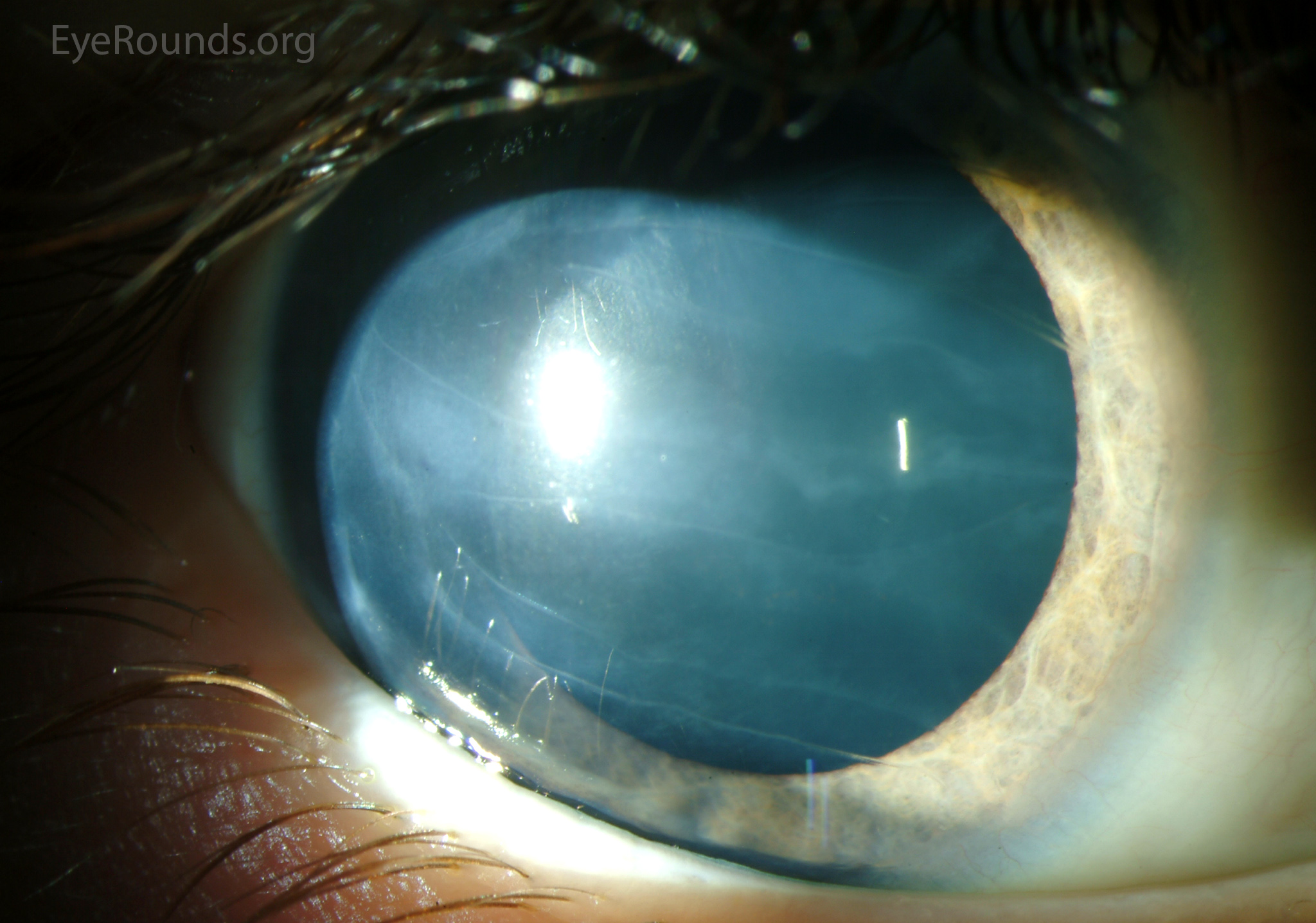 Clinical eye photograph illustrating Haab Striae