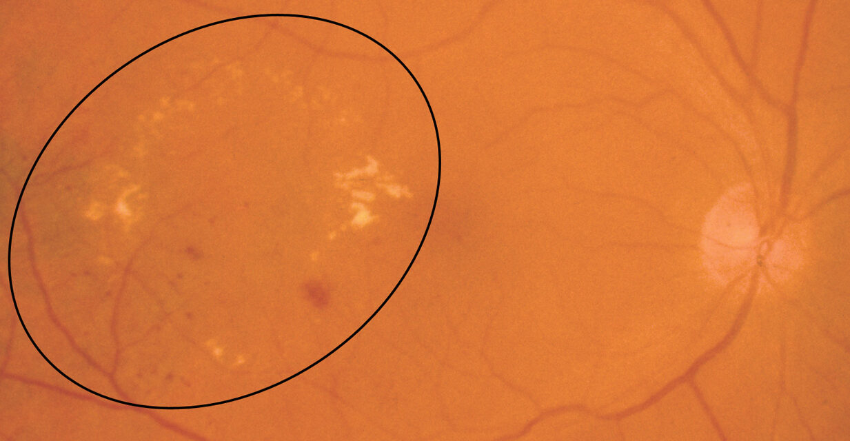 Hard Exudates: The Yellow Lipid Deposits That Tell You a Retinal Vessel Is Leaking