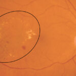 Clinical eye photograph illustrating Hard Exudates Retina