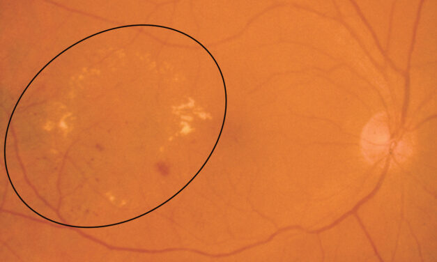 Hard Exudates: The Yellow Lipid Deposits That Tell You a Retinal Vessel Is Leaking