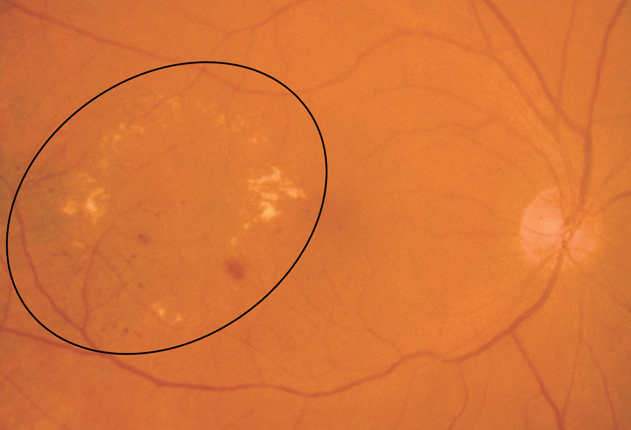 Clinical eye photograph illustrating Hard Exudates Retina