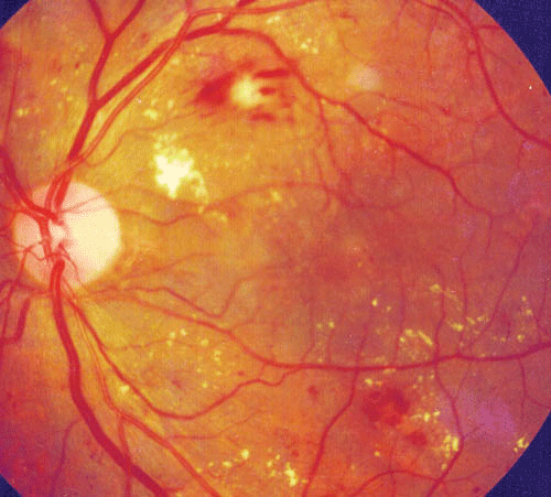 Clinical eye photograph illustrating Hard Exudates Retina