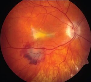 Clinical eye photograph illustrating Hawk Harrier Brolucizumab Neovascular Amd Trials