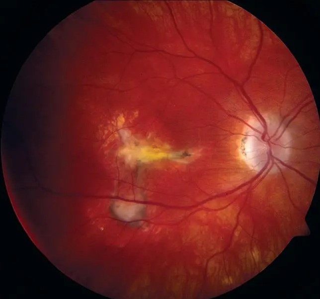 Clinical eye photograph illustrating Hawk Harrier Brolucizumab Neovascular Amd Trials