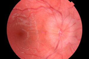 Clinical image illustrating Headache and the Eye