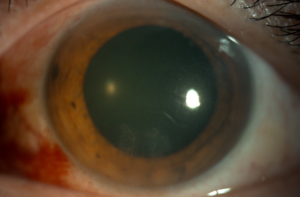 Clinical eye photograph illustrating Heavy Silicone Oil Inferior Retinal Detachment