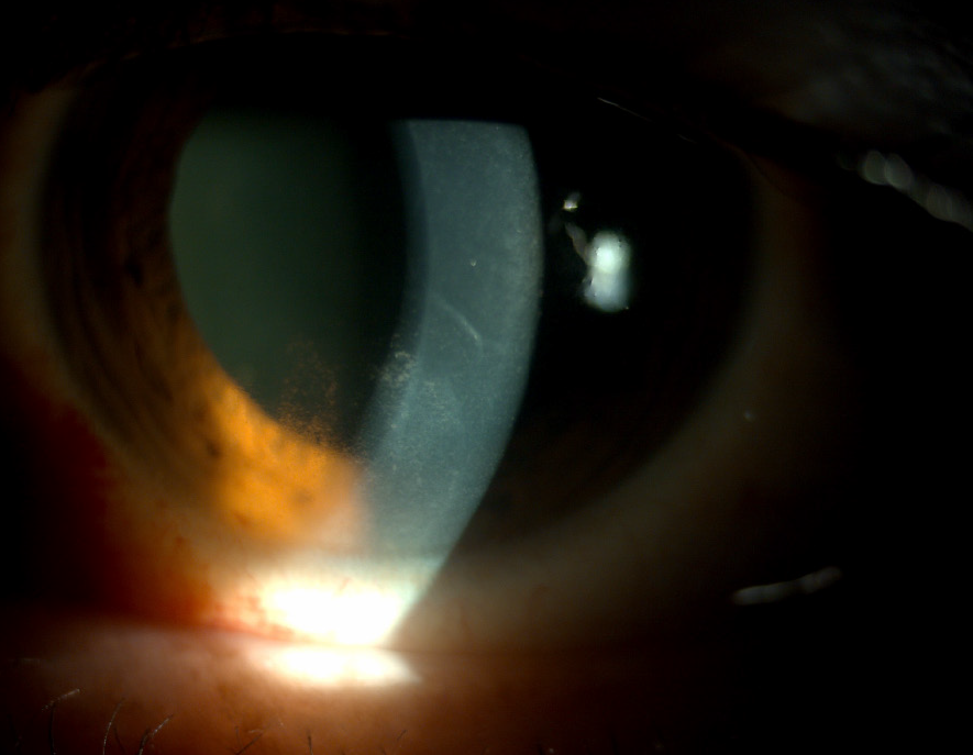 Clinical eye photograph illustrating Heavy Silicone Oil Inferior Retinal Detachment