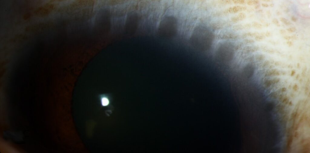 Clinical eye photograph illustrating Herberts Pits Trachoma Limbal Sign