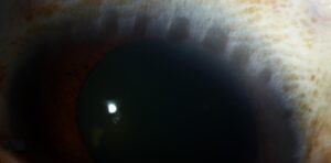 Clinical eye photograph illustrating Herberts Pits Trachoma Limbal Sign