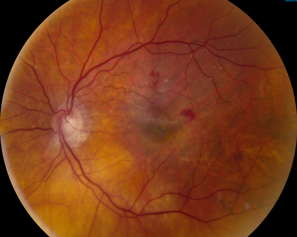 Clinical eye photograph illustrating Home Monitoring Amd Devices