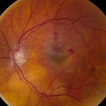 Clinical eye photograph illustrating Home Monitoring Amd Devices