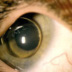 Clinical eye photograph illustrating Homocystinuria Ocular Findings