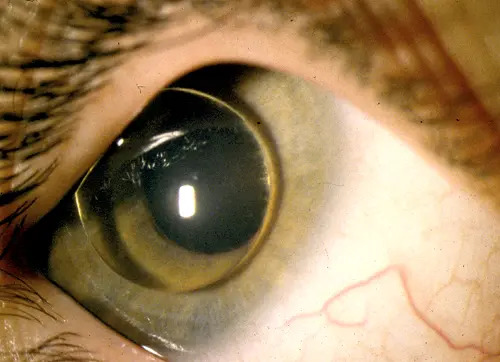 Homocystinuria: Ocular Findings, From Downward Lens Dislocation to Thromboembolic Risk