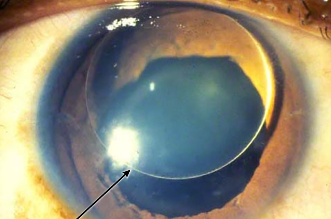 Clinical eye photograph illustrating Homocystinuria Ocular Findings
