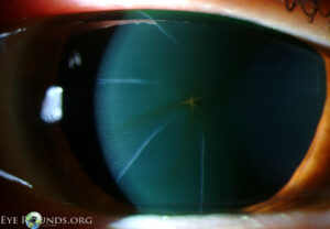Clinical eye photograph illustrating Hudson Stahli Line Corneal Iron Aging