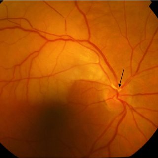 Clinical eye photograph illustrating Hyperbaric Oxygen Retinal Artery Occlusion Evidence