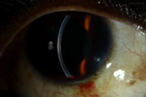 Clinical image illustrating Hyphema Grading (Blood in the Eye)