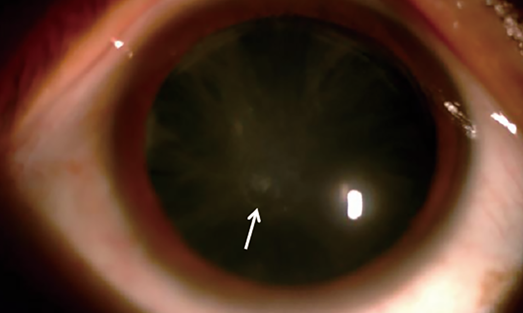 Hypocalcemic Cataract: Small Iridescent Flecks in the Lens That Point to Parathyroid Disease