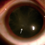 Clinical eye photograph illustrating Hypocalcemic Cataract