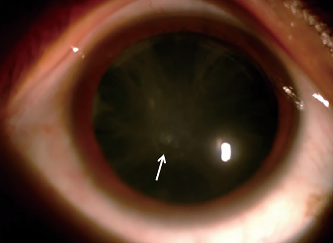 Clinical eye photograph illustrating Hypocalcemic Cataract