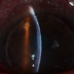 Clinical eye photograph illustrating Immunosuppression After Keratoplasty