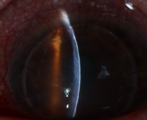 Clinical eye photograph illustrating Immunosuppression After Keratoplasty