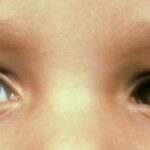 Clinical eye photograph illustrating Infantile Esotropia Surgical Timing