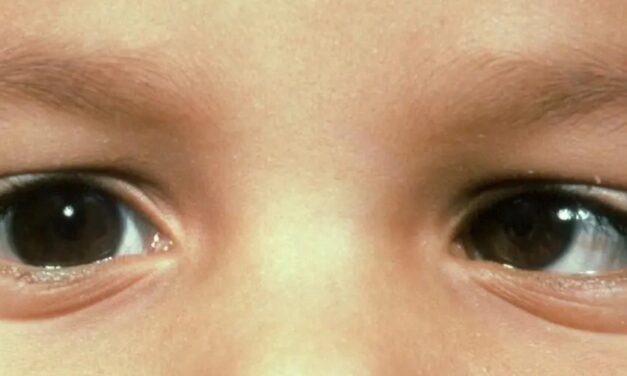 Infantile Esotropia: Why Surgical Timing Still Divides Opinion