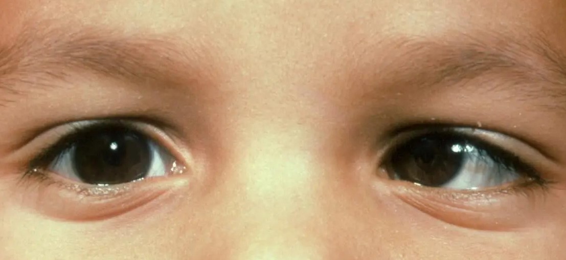Infantile Esotropia: Why Surgical Timing Still Divides Opinion