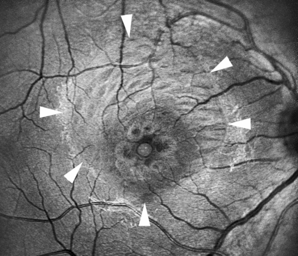 Internal Limiting Membrane Peeling: Indications, Technique, and the Effects on the Macula