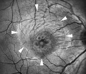 Clinical eye photograph illustrating Internal Limiting Membrane Peeling