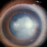 Clinical eye photograph illustrating Interstitial Keratitis Congenital Syphilis