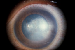Interstitial Keratitis: The Deep Corneal Clue to Congenital Syphilis