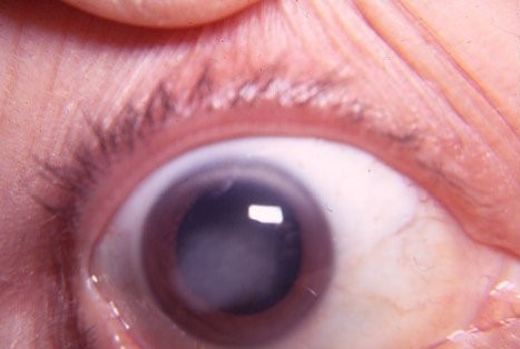 Clinical eye photograph illustrating Interstitial Keratitis Congenital Syphilis