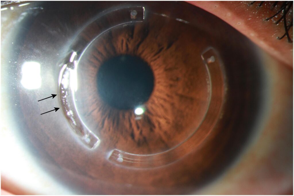 Intracorneal Ring Segments: Indications and Results