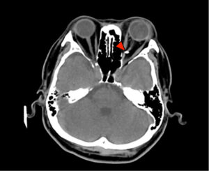 Clinical eye photograph illustrating Intraocular Foreign Body