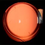 Clinical eye photograph illustrating Intraoperative Aberrometry