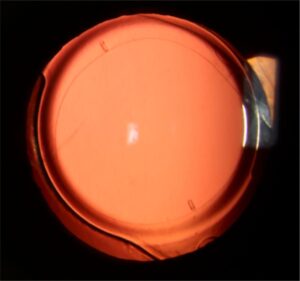 Clinical eye photograph illustrating Intraoperative Aberrometry