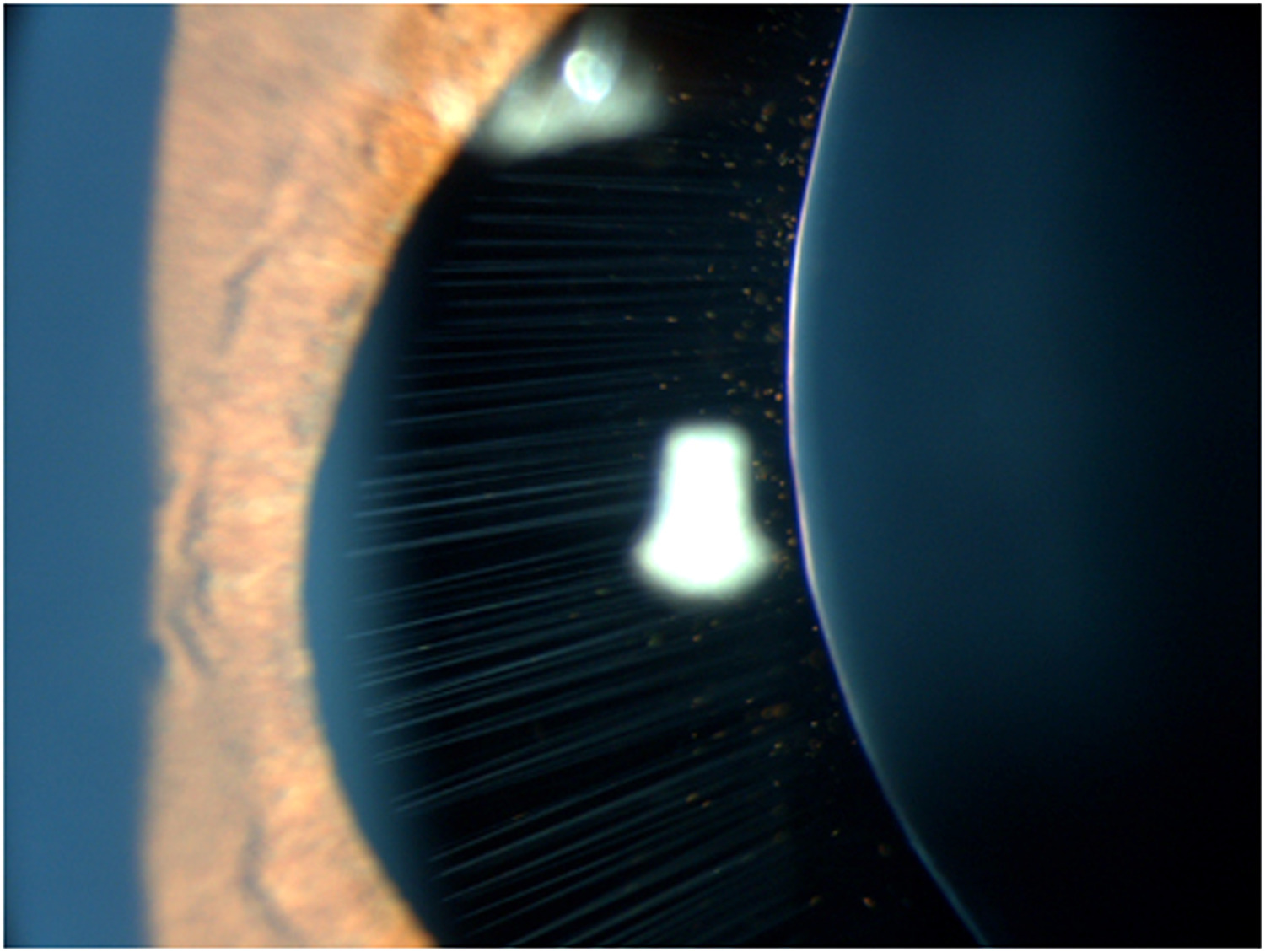 Clinical eye photograph illustrating Intraoperative Aberrometry