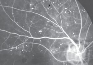 Clinical eye photograph illustrating Intraretinal Microvascular Abnormalities