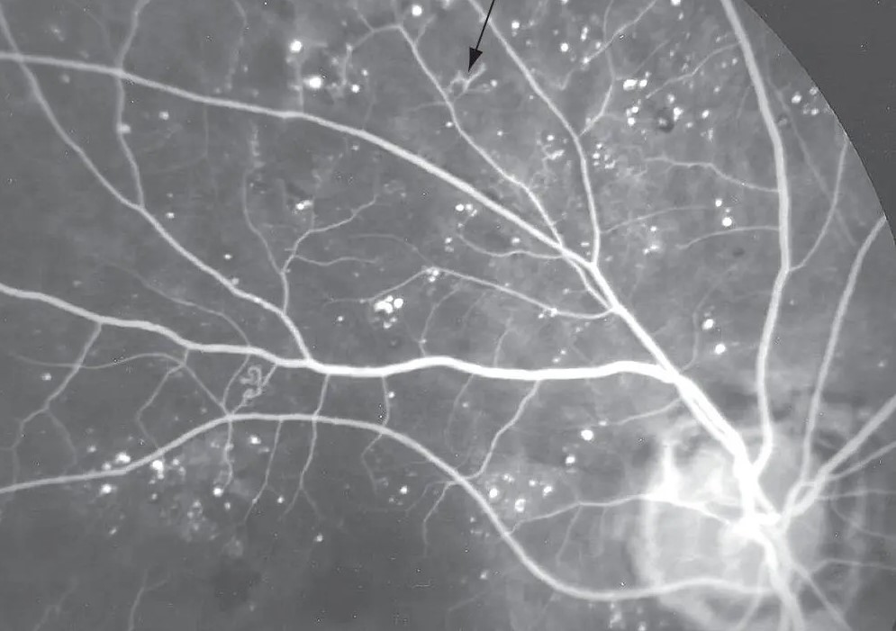 Clinical eye photograph illustrating Intraretinal Microvascular Abnormalities