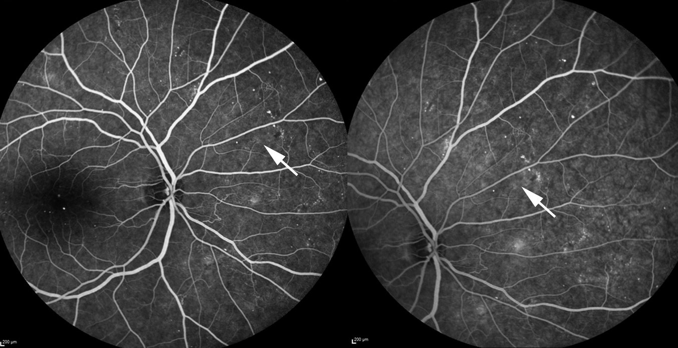 Clinical eye photograph illustrating Intraretinal Microvascular Abnormalities