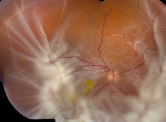 Clinical eye photograph illustrating Intravitreal Methotrexate Proliferative Vitreoretinopathy